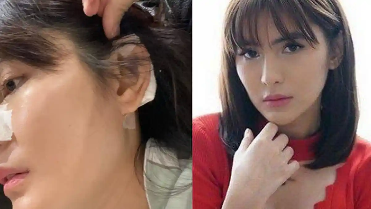 Implan Jebol hingga Tembus ke Kulit, Angela Lee Akui Menyesal Operasi Hidung: Kapok Banget Dah