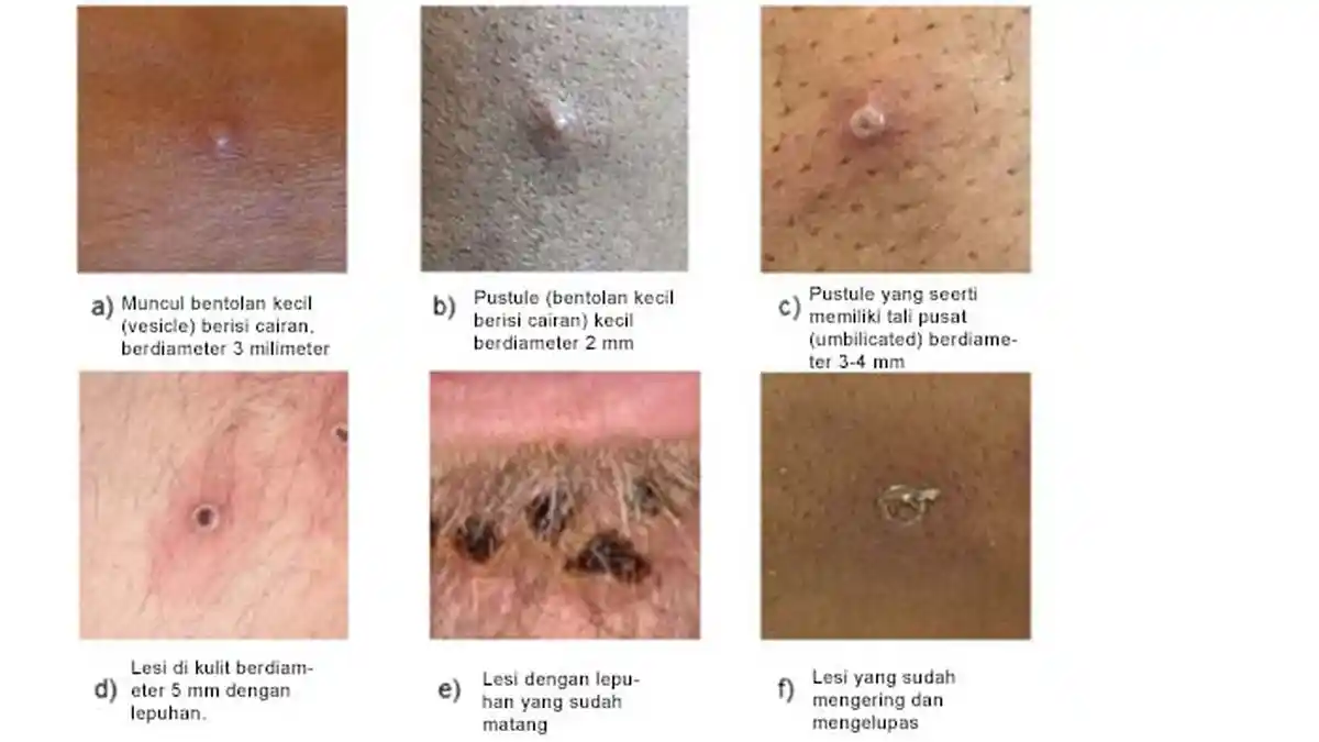Virus Cacar Monyet Menular ketika Gejalanya Sudah Terlihat