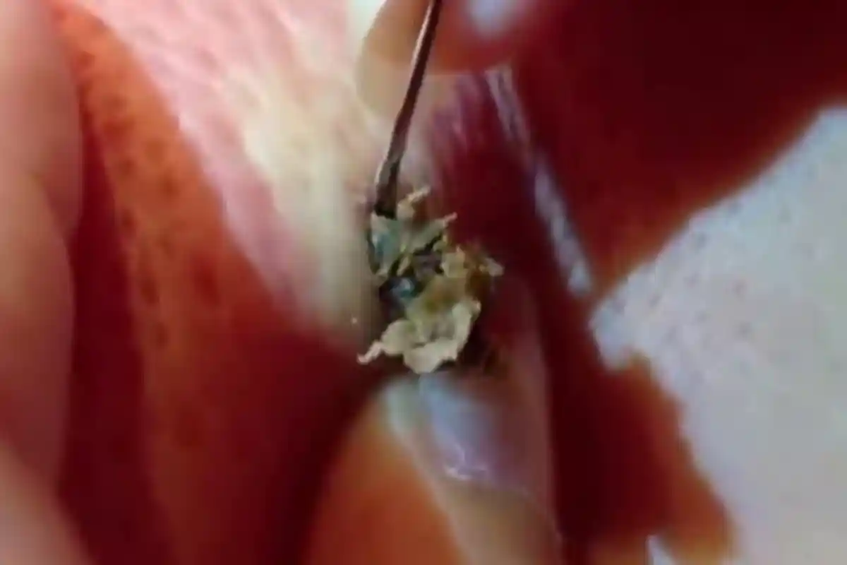 Yang Terjadi Pada Komedo Setelah 25 Tahun Dibiarkan, Begini Proses Pembersihannya, Yakin Mau Nonton?