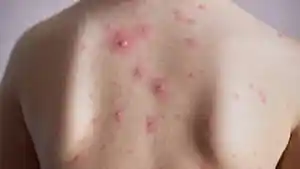 jerawat-punggung.jpg