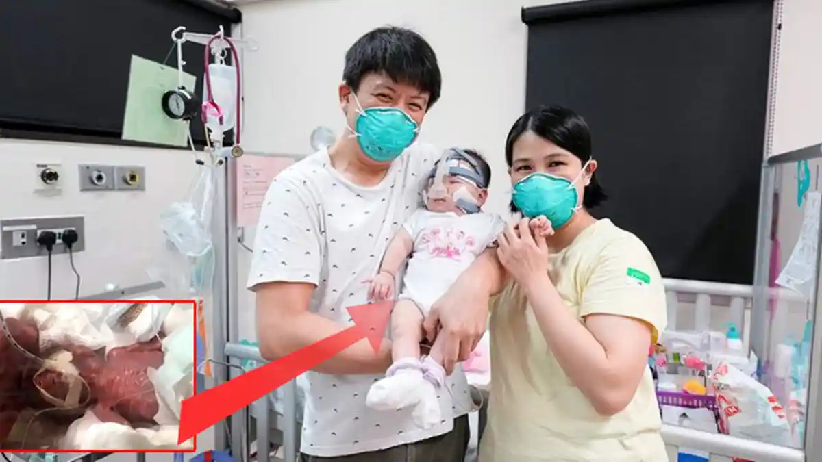 AJAIB! Bayi Terkecil di Dunia Ini Bisa Tumbuh Besar, Saat Dilahirkan Ibunya Hanya Seberat Buah Apel
