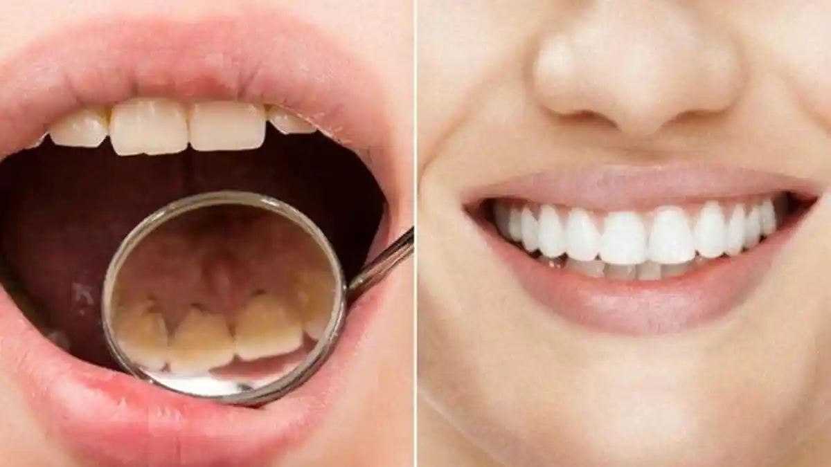 Karang Gigi Bisa Hilang Dengan 3 Bahan Ini, Berikut Lengkap Cara Menggunakannya