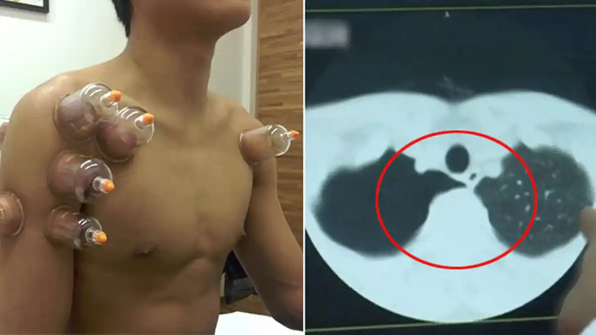 Astaga! Niat Obati Batuk Pakai Terapi Bekam, Pria Ini Alami Nasib Mengerikan, Lihat Paru-parunya!