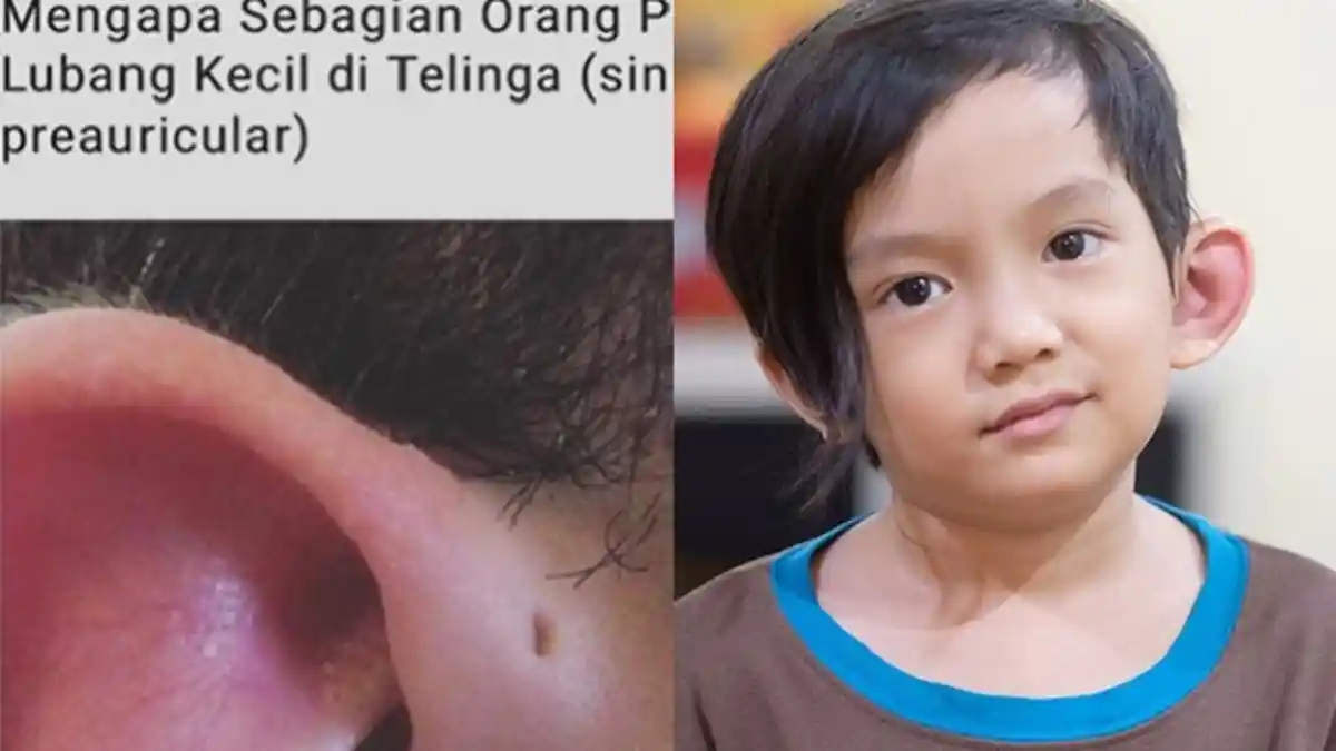 4 Fakta Sinus Preauricular, Lubang Kecil yang Membuat Telinga Anak Anji Saga Omar Nagata Infeksi