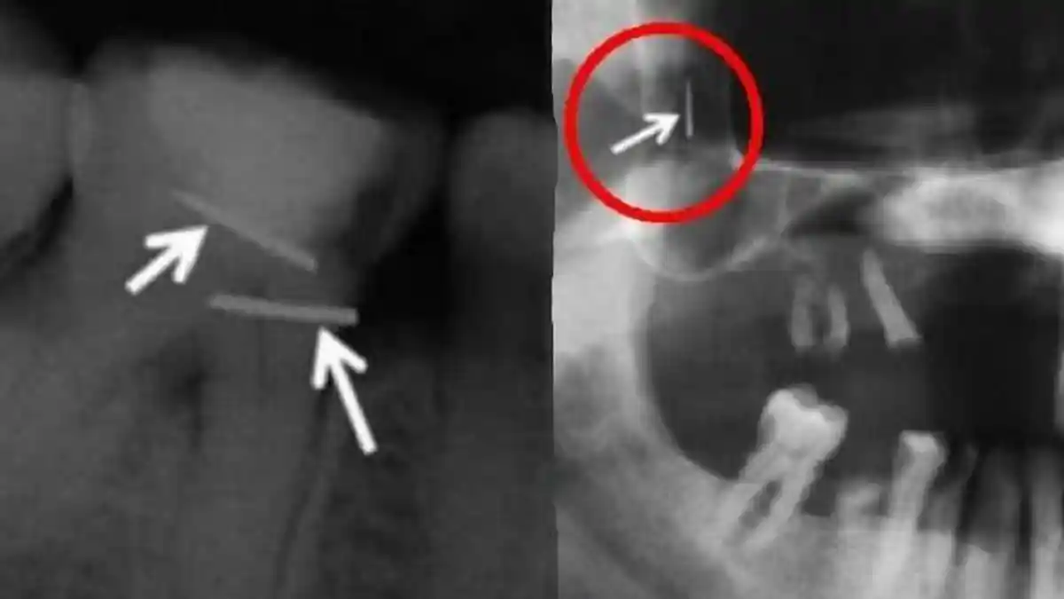 Awalnya Ngeluh Sakit Gigi, Dokter Syok Temukan Dua Jarum Besar di Rahang, Pasien: Susuk Kecantikan
