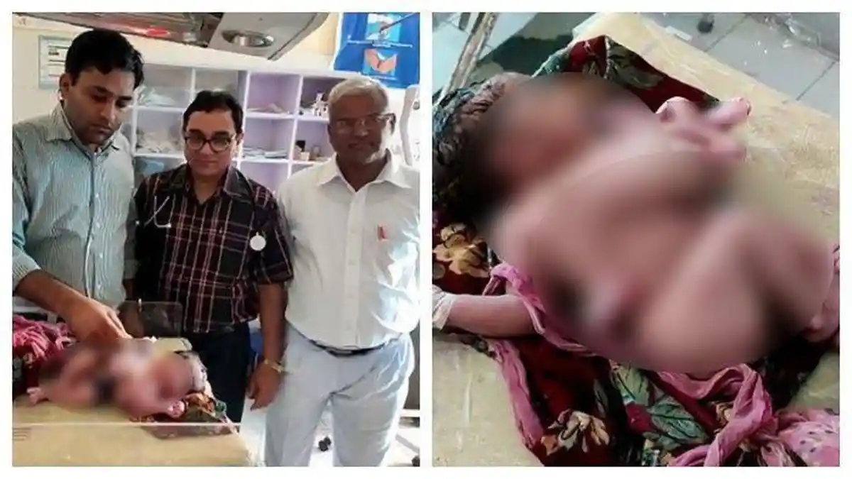 Seorang Ibu lahirkan Bayi 4 Kaki dan 3 Tangan, Dokter Jelaskan Penyebabnya