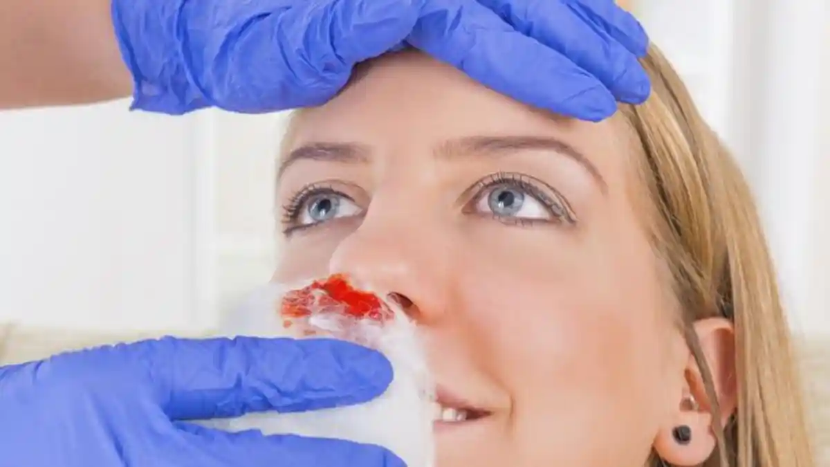 JANGAN Panik, Begini Cara Atasi Mimisan dengan Baik