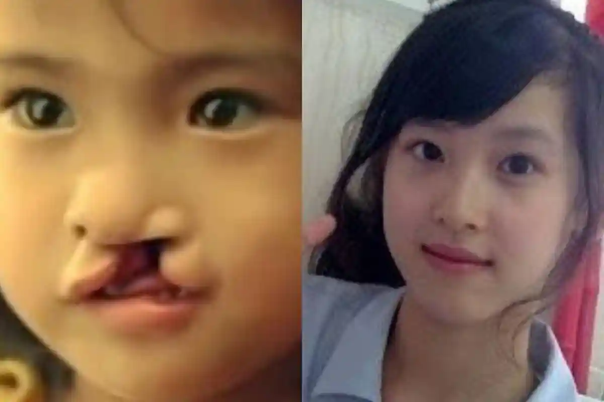 Kisah Gadis Bibir Sumbing Dibuang Orang Tua Kandung, Setelah Dewasa Justru Cantik dan Sukses