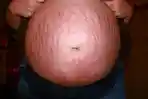 ilustrasi-stretch-mark-saat-hamil.jpg