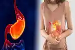 Penyebab-Kambuhnya-GERD-dan-Asam-Lambung-Akut.jpg