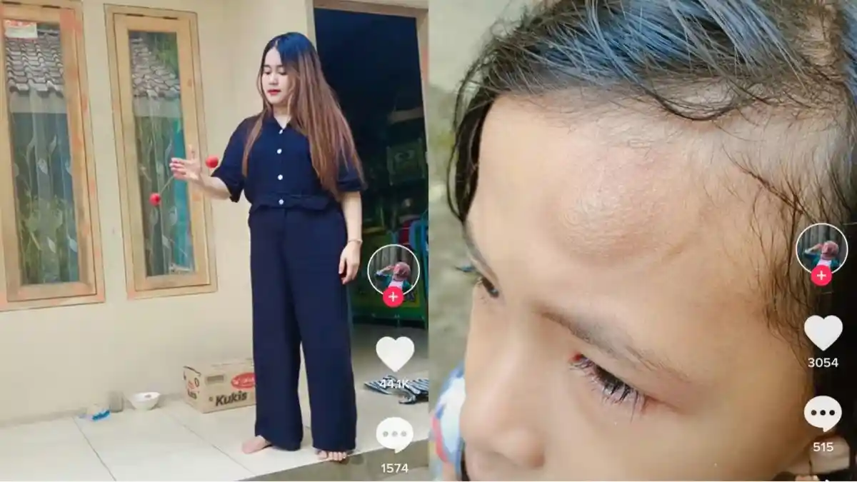 Viral Jidat Bocah Benjol Gara-gara Lato-lato, Warganet: Kameramen Paling Apes Nih