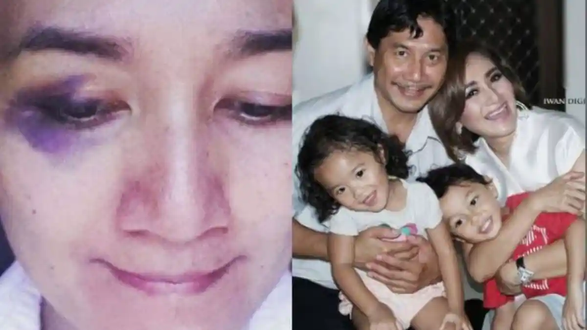 Unggah Foto Muka Lebam, Nini Carlina Alami KDRT?