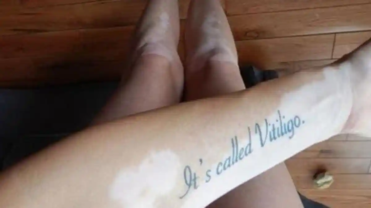 Wanita Ini Membuat Tato di Atas Kelainan Warna Kulitnya