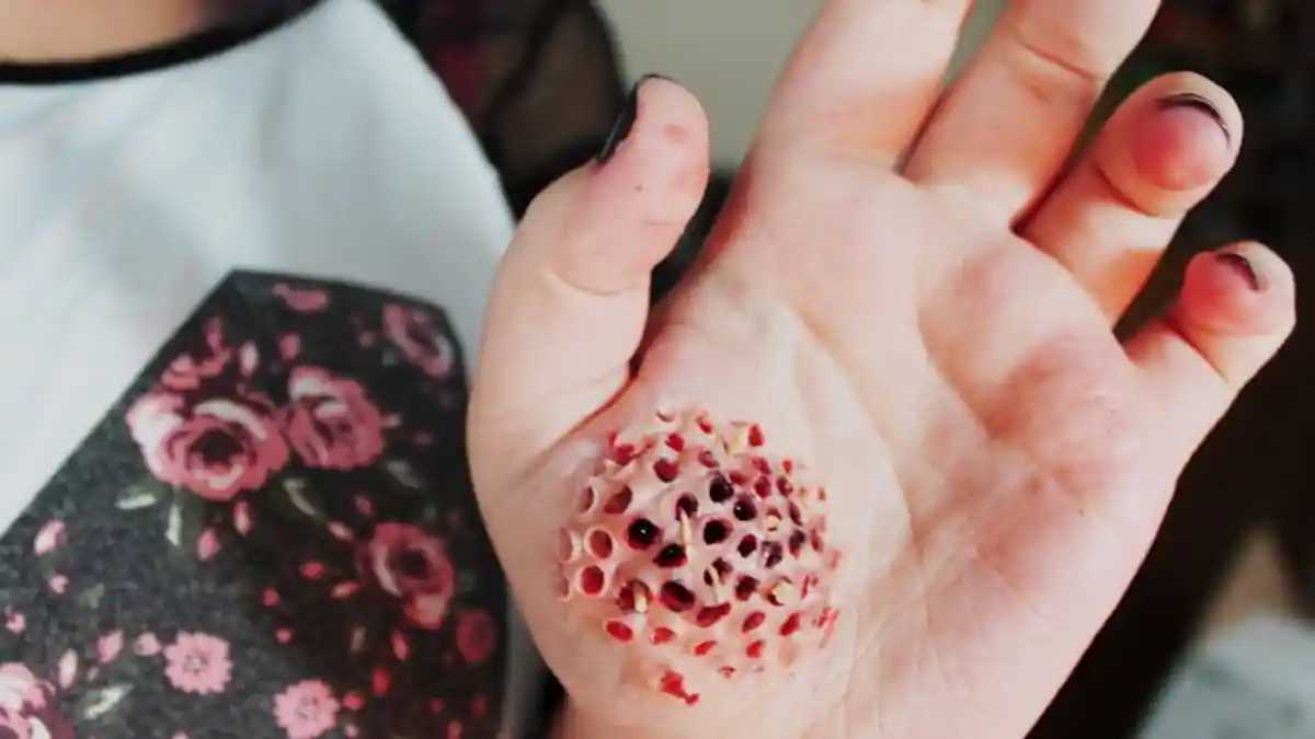 Bulu Kudukmu Berdiri & Merinding Lihat Gambar Ini? Anda Alami Trypophobia, Begini Cara Sembuhkan