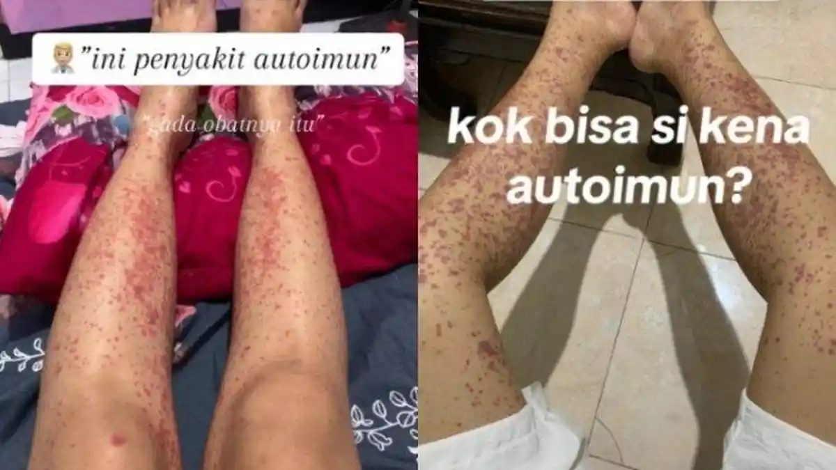 Gara-gara Sering Jajan di Luar, Wanita Ini Syok Divonis Idap Autoimun, Mulanya Muncul Bercak Merah