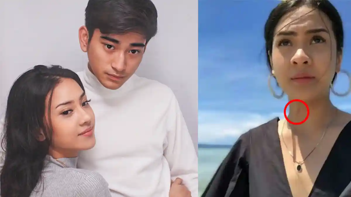 Liburan Bareng Pacar Baru, Tanda Merah di Leher Anya Geraldine Bikin Salfok!
