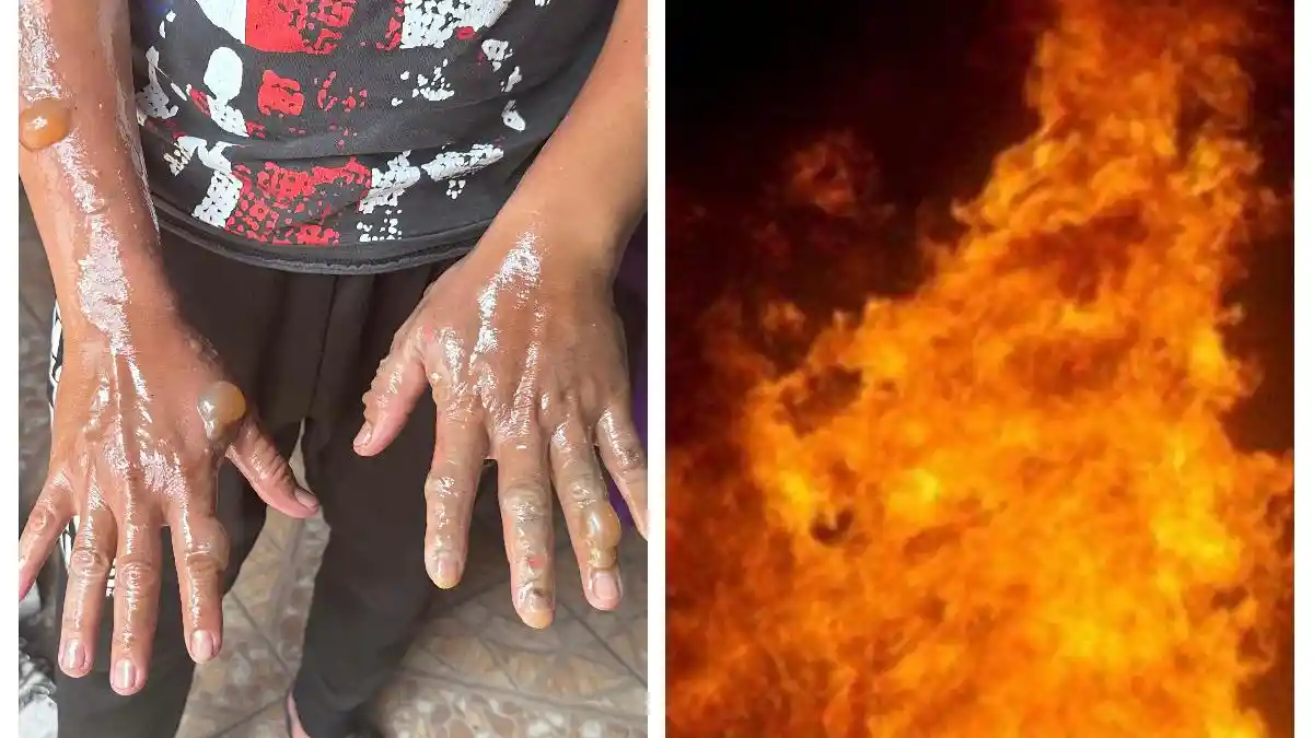 Panik Laundrynya Terbakar, Warga Munjul Tak Sadar Tangan Melepuh saat Padamkan Api