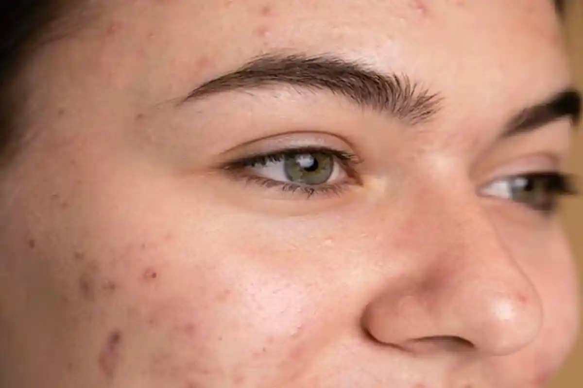 dr Desidera Beberkan Waktu yang Dibutuhkan untuk Menyembuhkan Skin Barrier yang Rusak