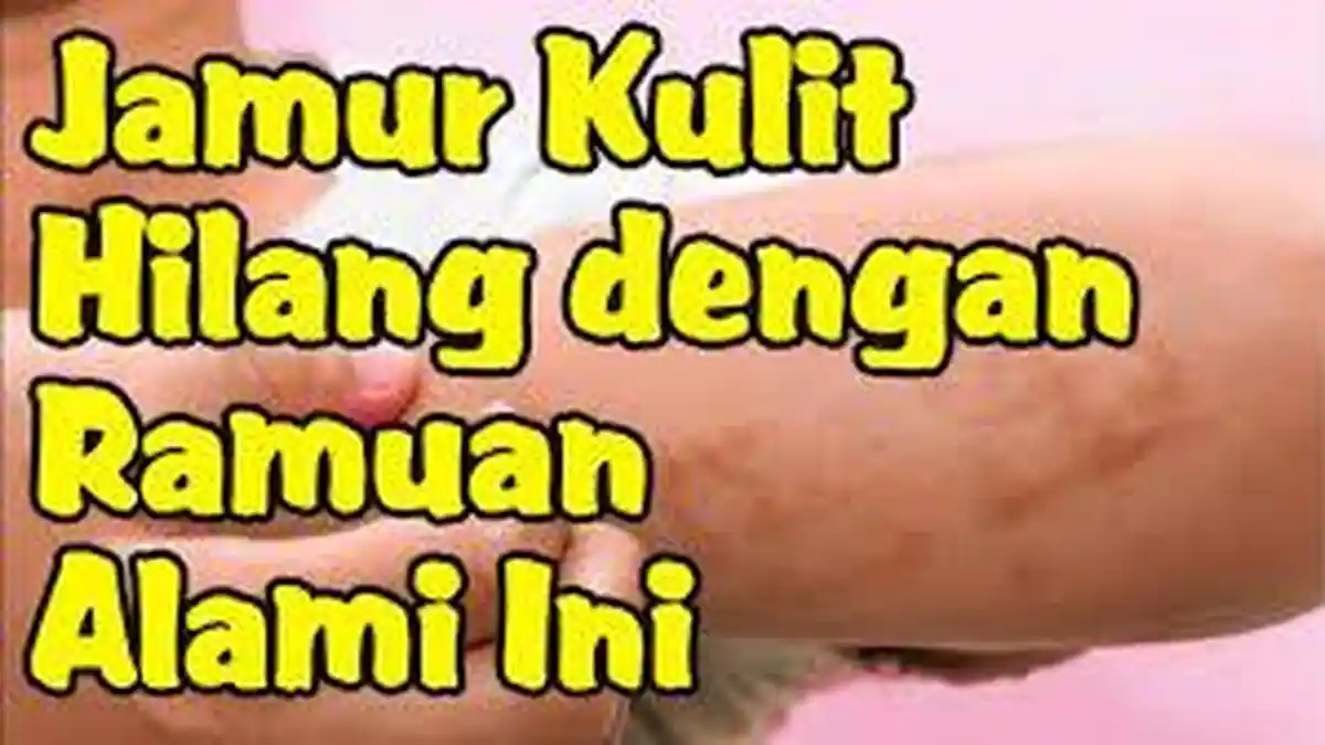 5 Cara Mudah dan Ampuh Mengatasi Jamur Kulit dengan Cepat, Tanpa Harus Pergi ke Dokter