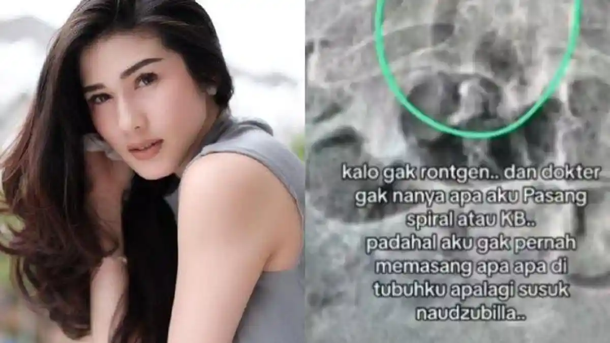 Penjelasan Dokter Soal Hasil Rontgen Stevie Agnecya Bikin Merinding, Ada Benda Aneh Sepanjang 10 Cm