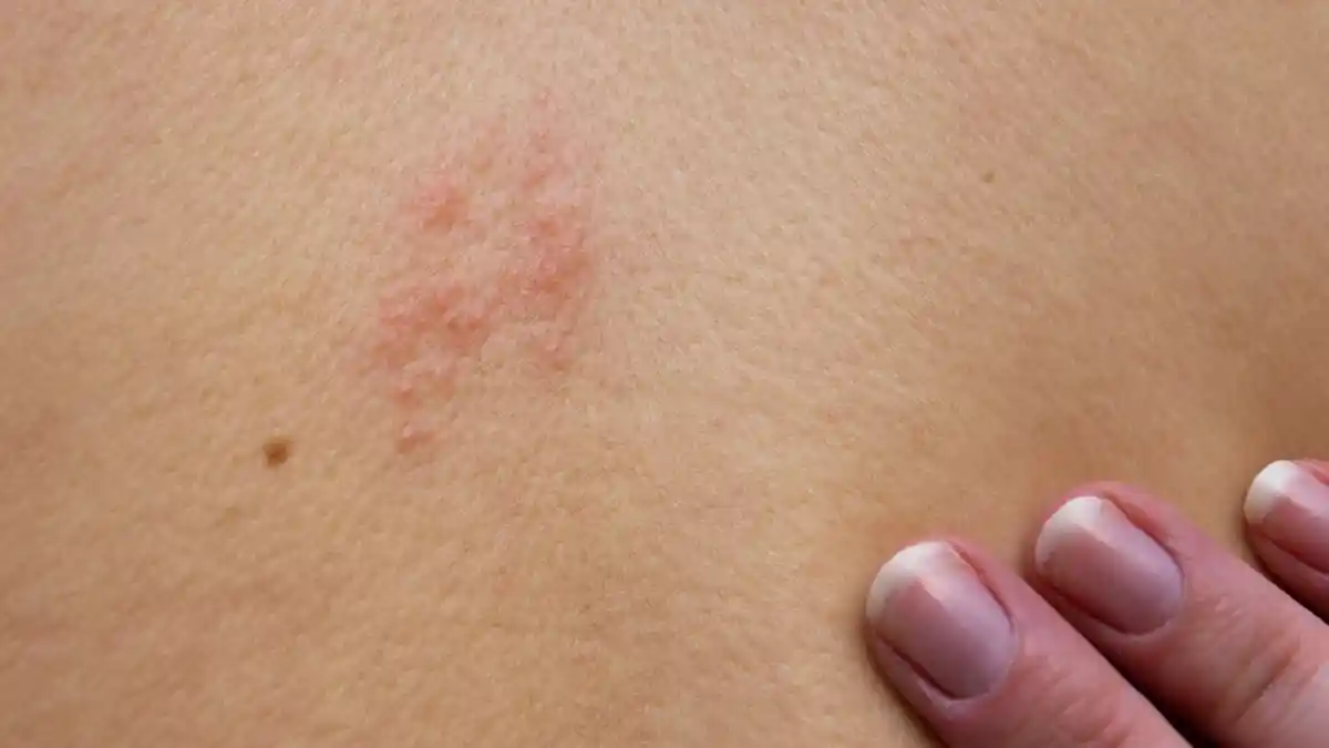Terkena Penyakit Herpes? Ini Cara Paling Tepat Menanganinya