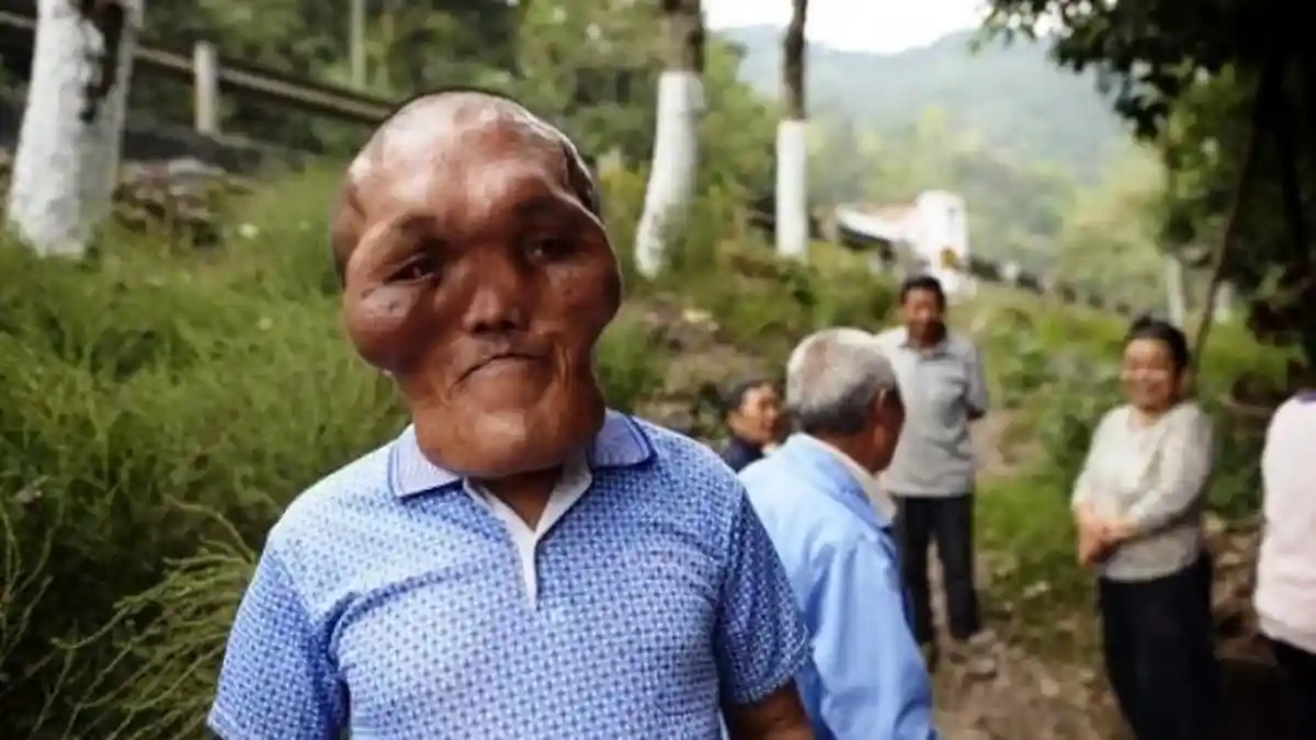 Saat Tumbuh Dewasa Wajah Pria Ini Berubah Menjadi Seperti Alien
