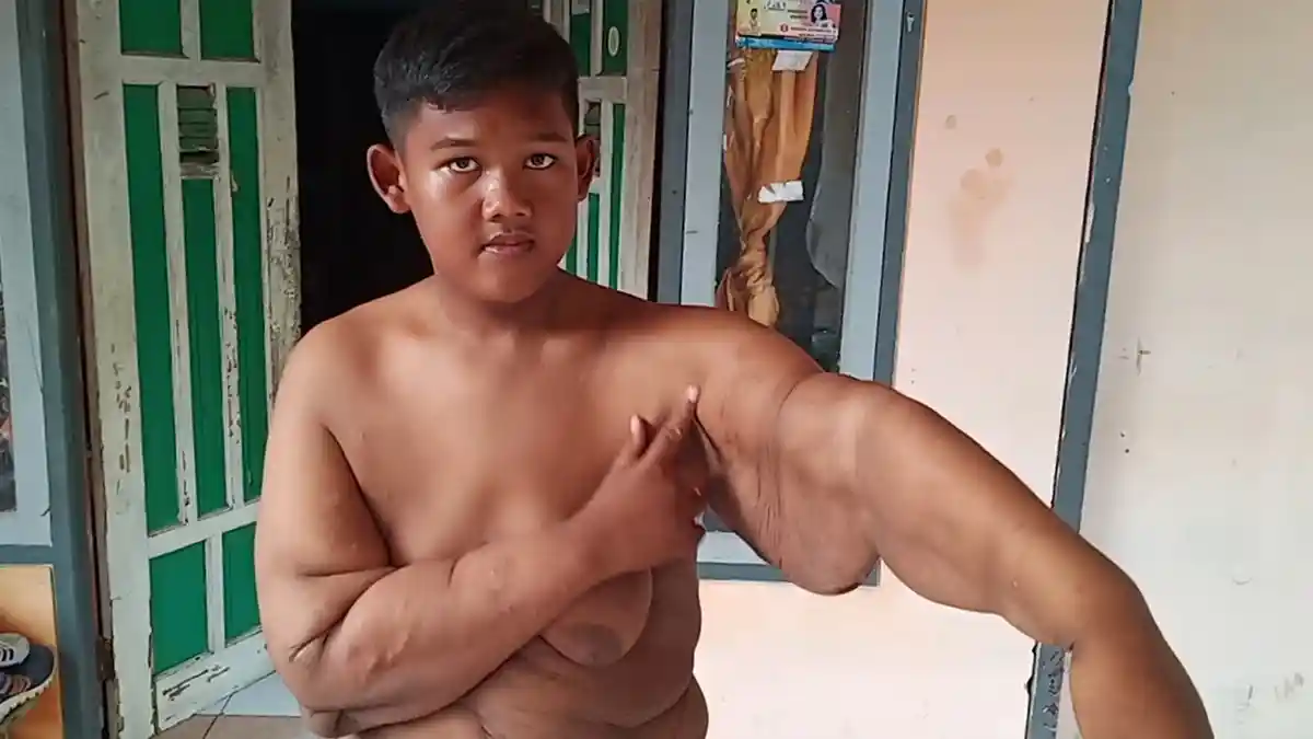 Aria Permana Jalani Operasi Pengangkatan Gelambir di RSHS Bandung Hari Ini