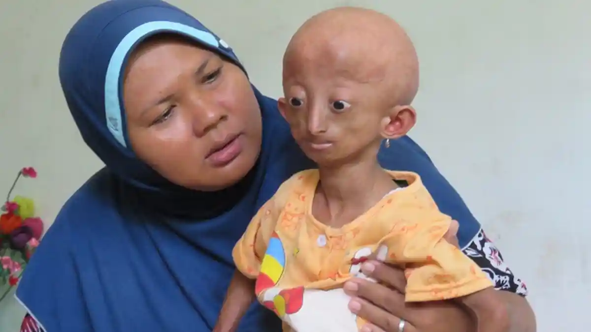 Bocah di Nagan Raya Didera Sindrom Progeria, Usia 8 Tahun Wajahnya Sudah Menua